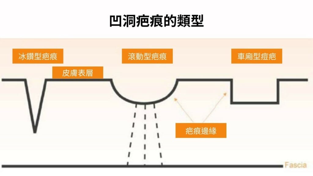 如何讓臉上的坑洞不見