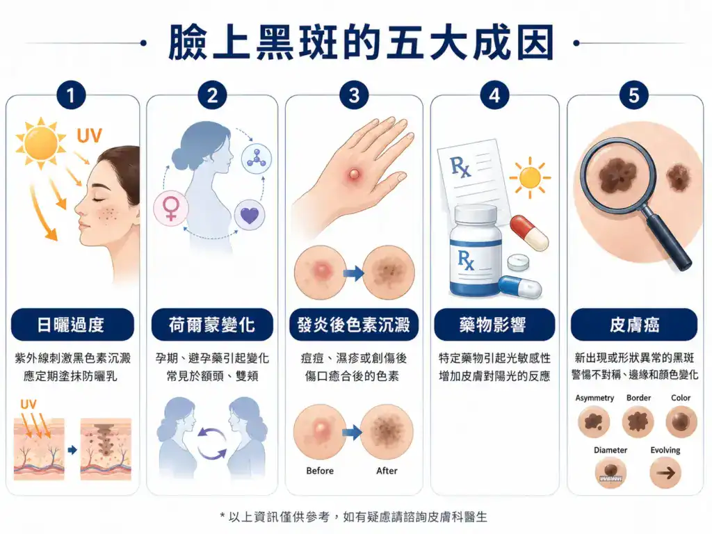 五大黑斑原因的圖解，包含日曬過度、荷爾蒙變化、發炎後色素沉澱、藥物影響與皮膚癌警訊