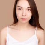 blemish, acne, pimple, remove