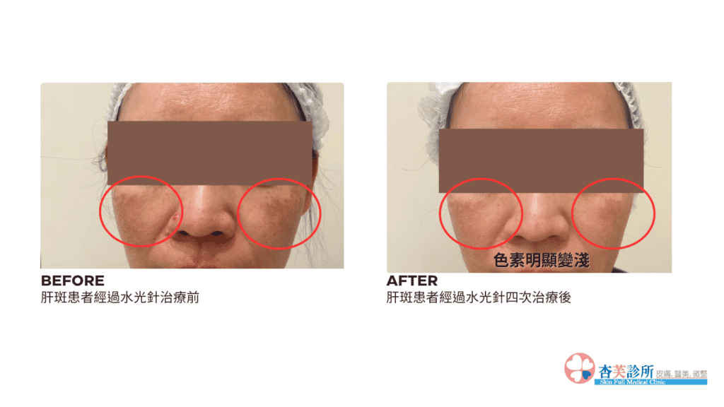 肝斑 水光針