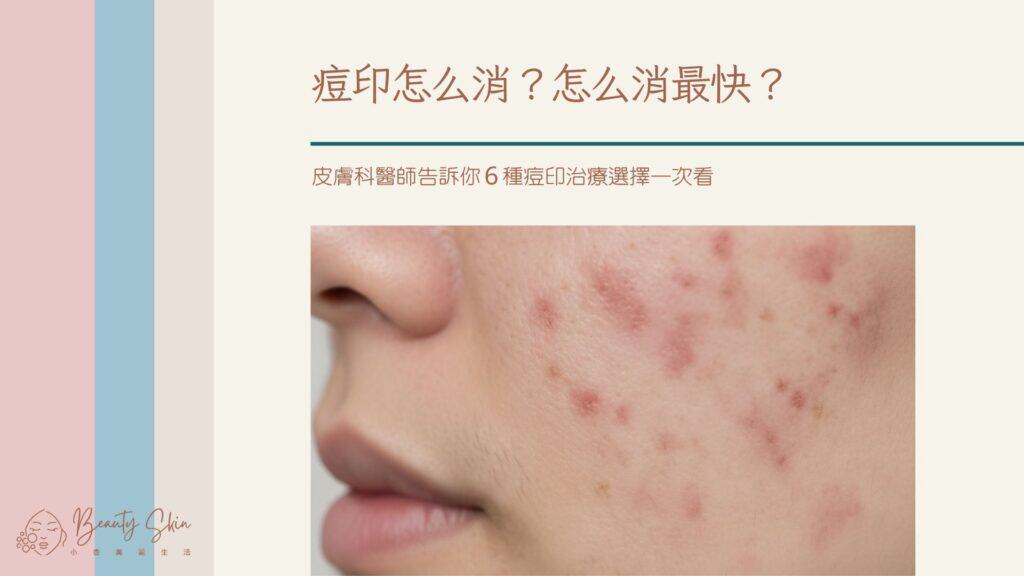 痘印怎么消