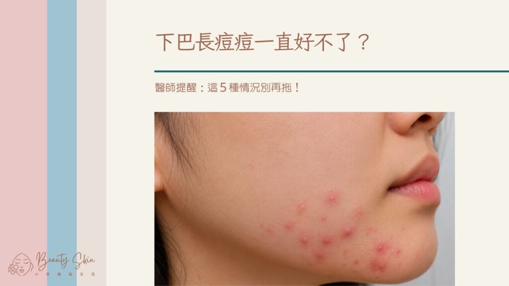 下巴長痘痘