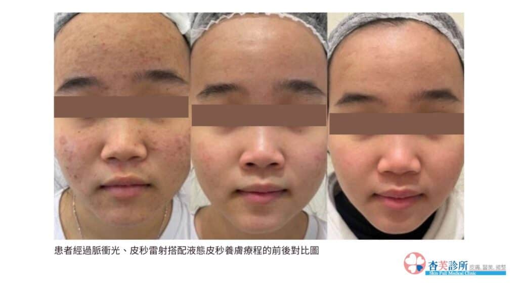 如何快速消除痘痘