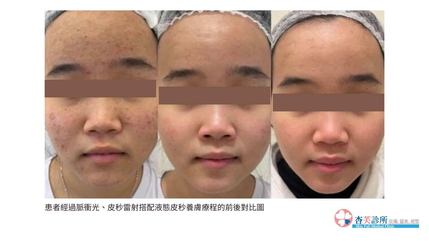 如何快速消除痘痘