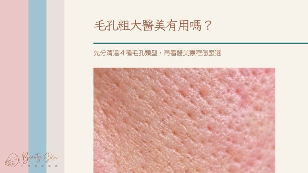 毛孔粗大醫美