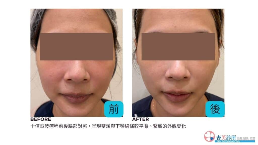 十蓓電波術前術後臉部對照,雙頰與下顎線條變得較平順緊緻