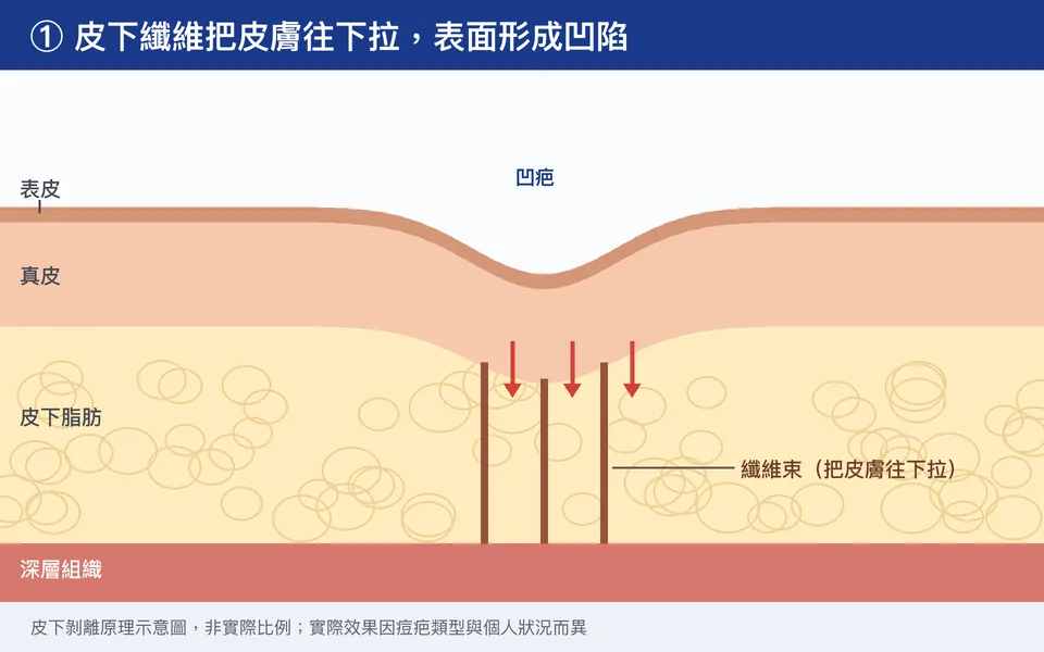 皮下剝離原理示意動畫：皮下纖維把皮膚往下拉形成凹疤，器械鬆開或切斷纖維後，皮膚有機會回到較平的位置